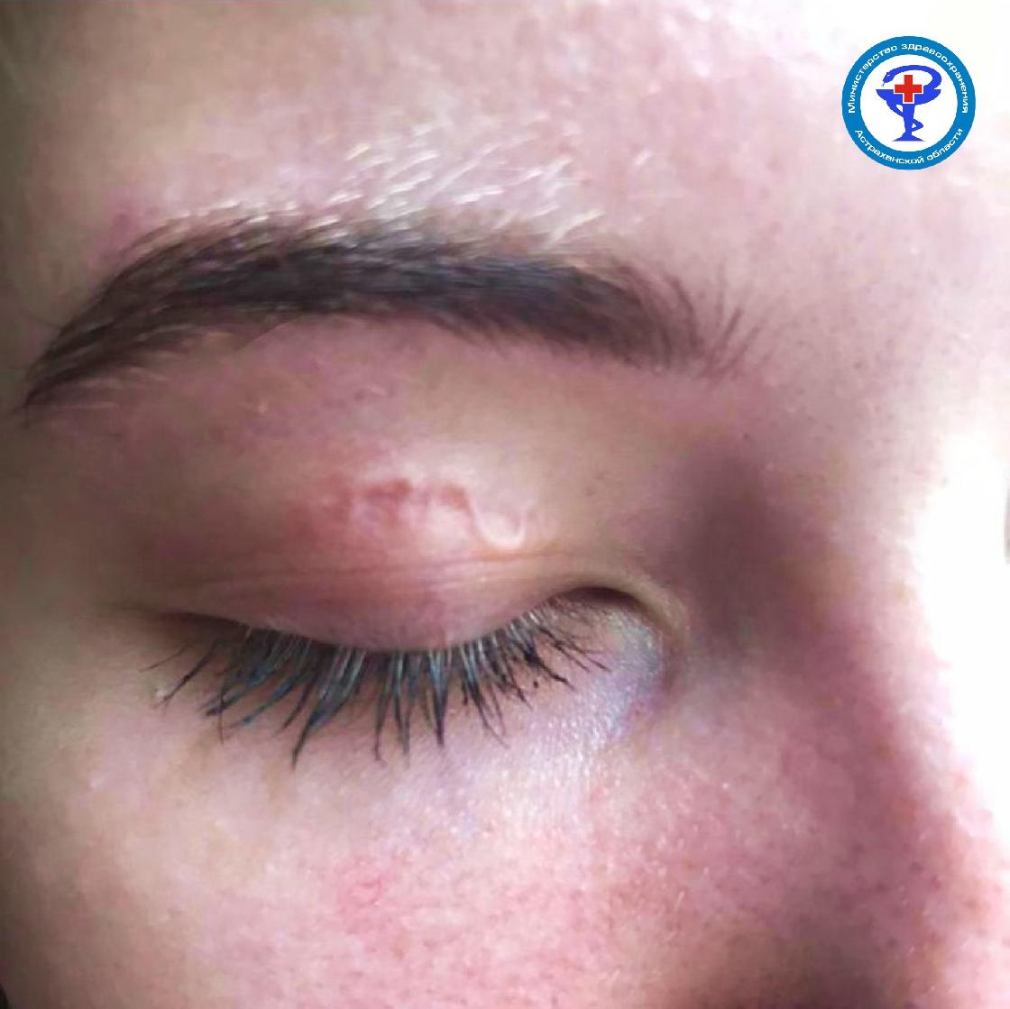 Врачи в Астрахани удалили из глаза подростка 12-сантиметрового гельминта